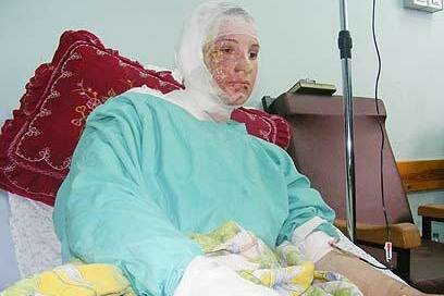 Ghada Abu Halima, 21, who was gravely injured by IDF white phosphorus in Gaza. Abu Halima later died of her wounds